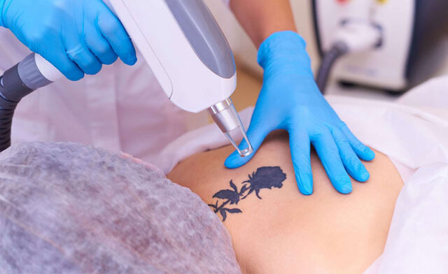 Exactly How Laser Tattoo Removal Works? 10 Caveats of Tattoo Removal