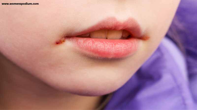 Health Benefits of Amla - Treats Mouth Ulcers