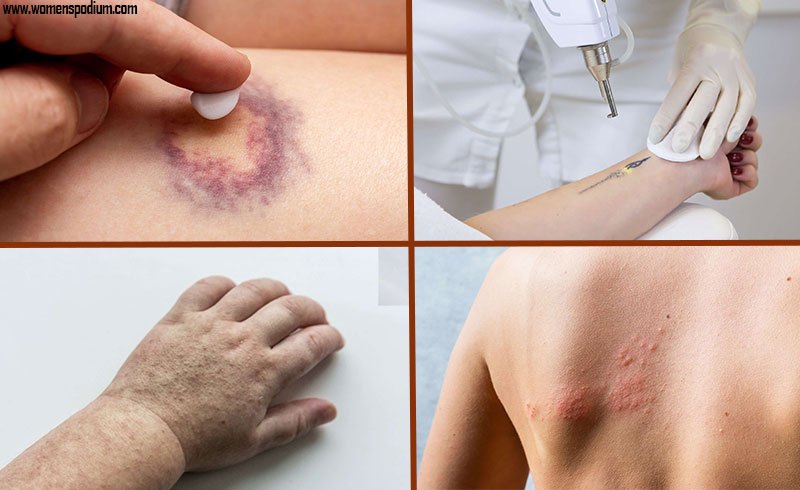 Immediate Complications - how laser tattoo removal works
