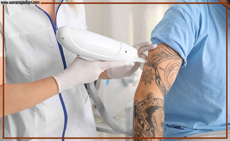 what is laser tattoo removal