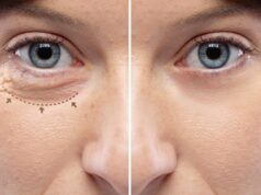 How Long Does A Blepharoplasty Last 2024 Guide
